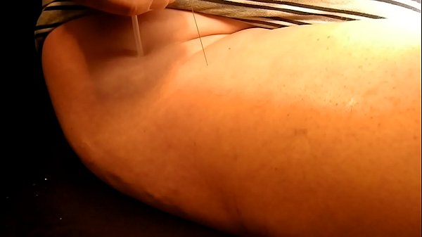 Acupuncture 2 With Playerdoi