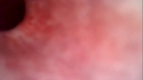 Urethra Fiber Scope